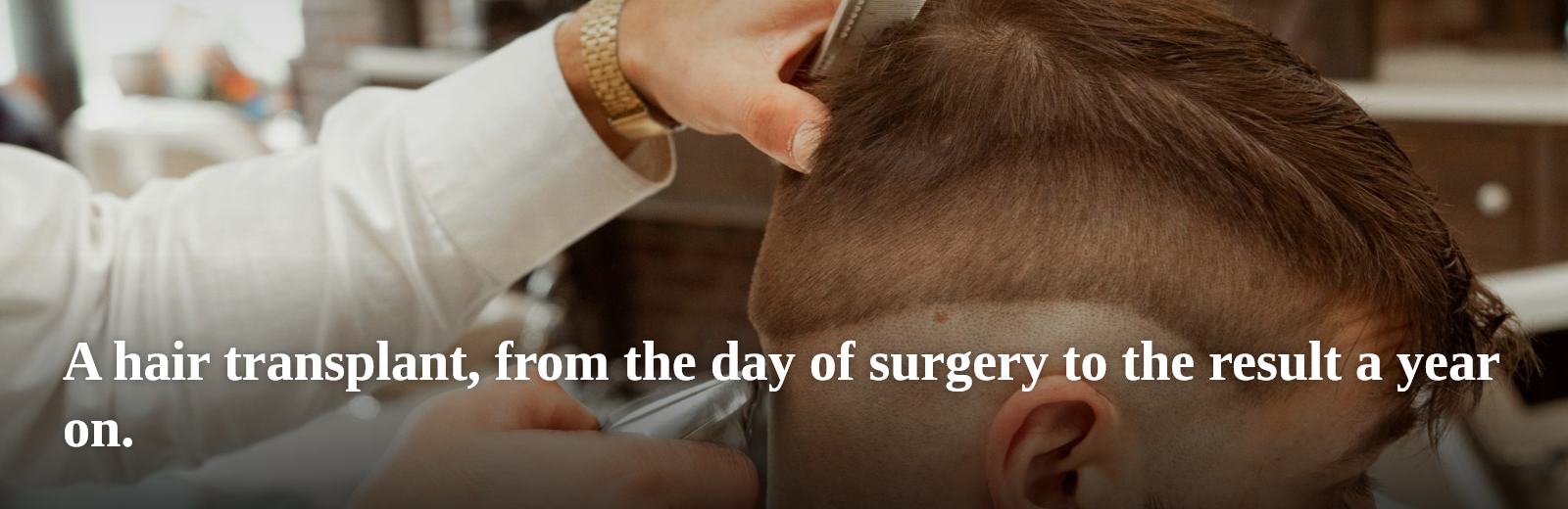 A hair transplant, from the day of surgery to the result a year on.